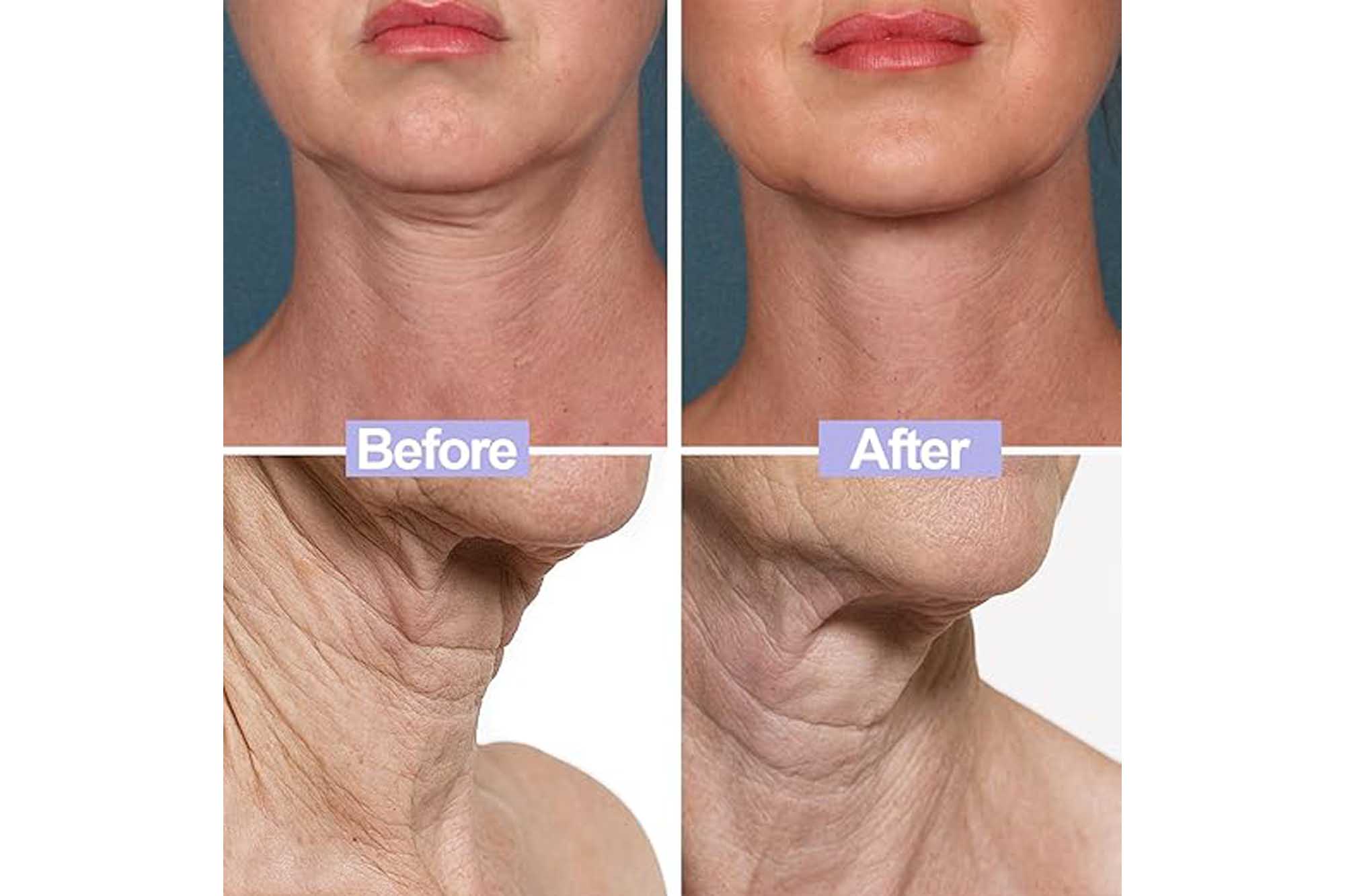 Neck Cream