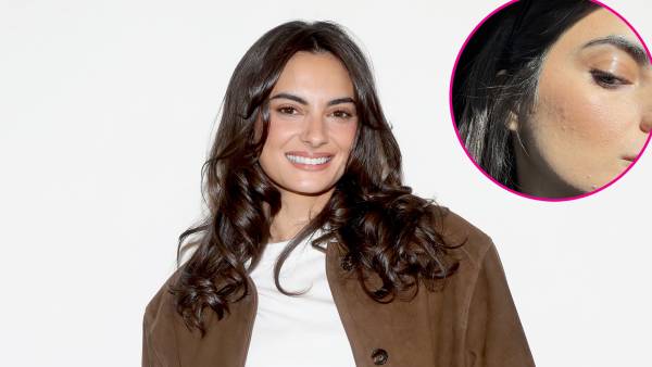 Paige DeSorbo Gives Realistic Look at Her Acne