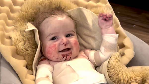 What is Epidermolysis Bullosa Explainer
