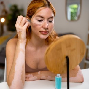 Young redhead Caucasian woman, with vitiligo and acne on her face, doing a skin care in her home (Photo by Nadija Pavlovic/Getty Images)