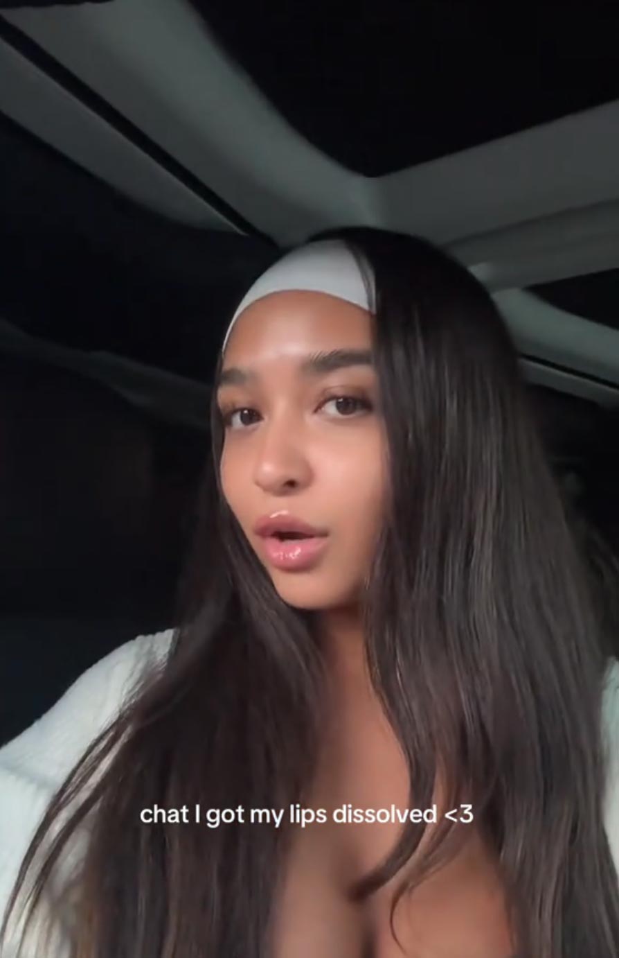 Love Islands Cierra Ortega Dissolves Lip Filler After Getting Online Criticism See Her Results