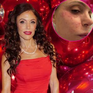 Bethenny Frankel Shows Face Covered in a Rash After Catching a Bacterial Infection in St Barts