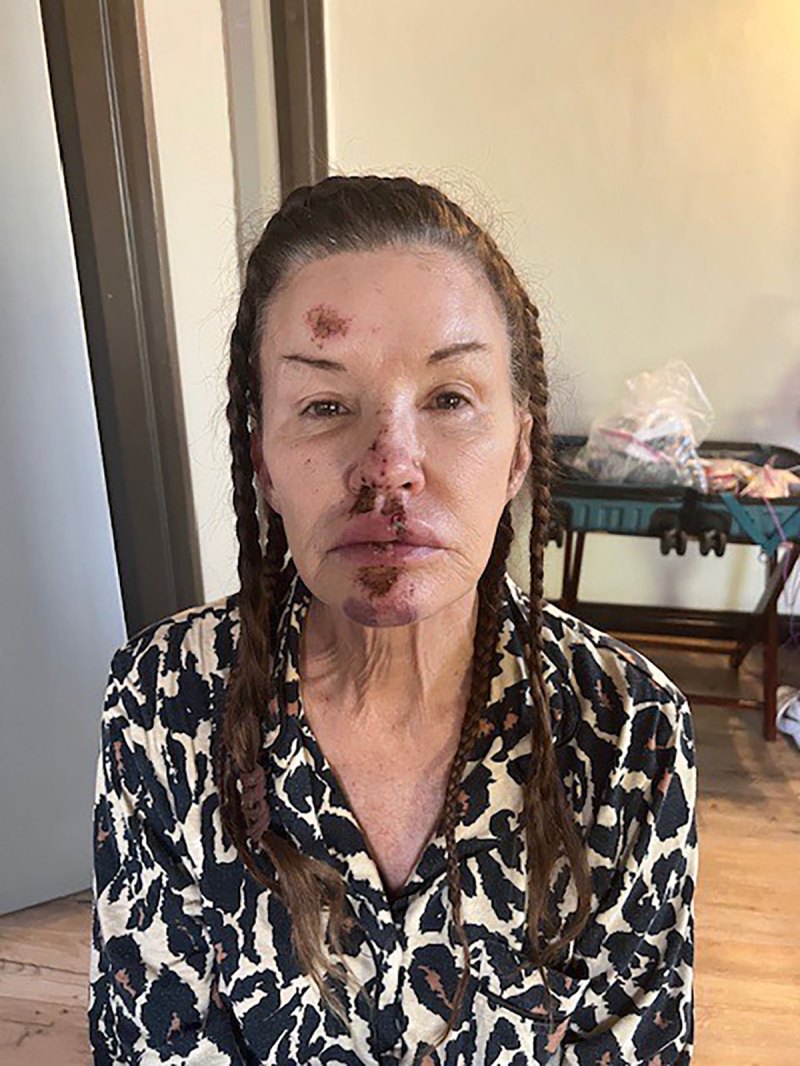 Janice Dickinson Shares Photos From Brutal OnSet Injury Amid Lawsuit