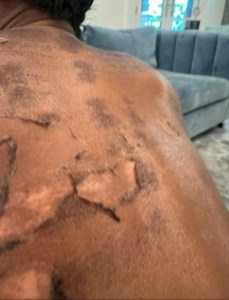 Doctor Fighting RHOAs Shamea Morton Over Chemical Peel Lawsuit
