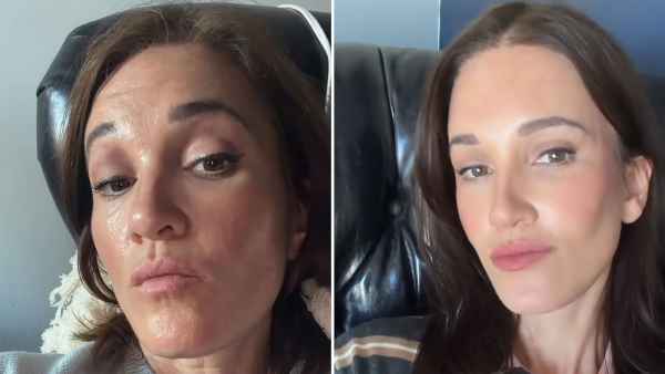 Influencer Katie Anderson Reveals the Results of Her 2nd Facelift at 48