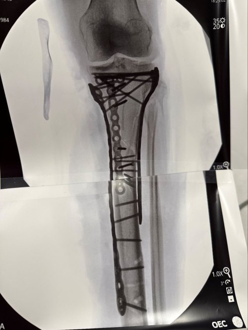 Lindsey Vonn Shares Graphic X-Ray of Broken Leg After 2026 Olympics ...