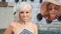 Margaret Josephs 58 Shows Off Nose Job Results After Being Bruised and Bandaged
