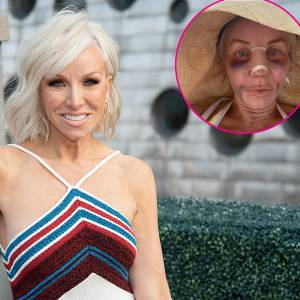 Margaret Josephs 58 Shows Off Nose Job Results After Being Bruised and Bandaged