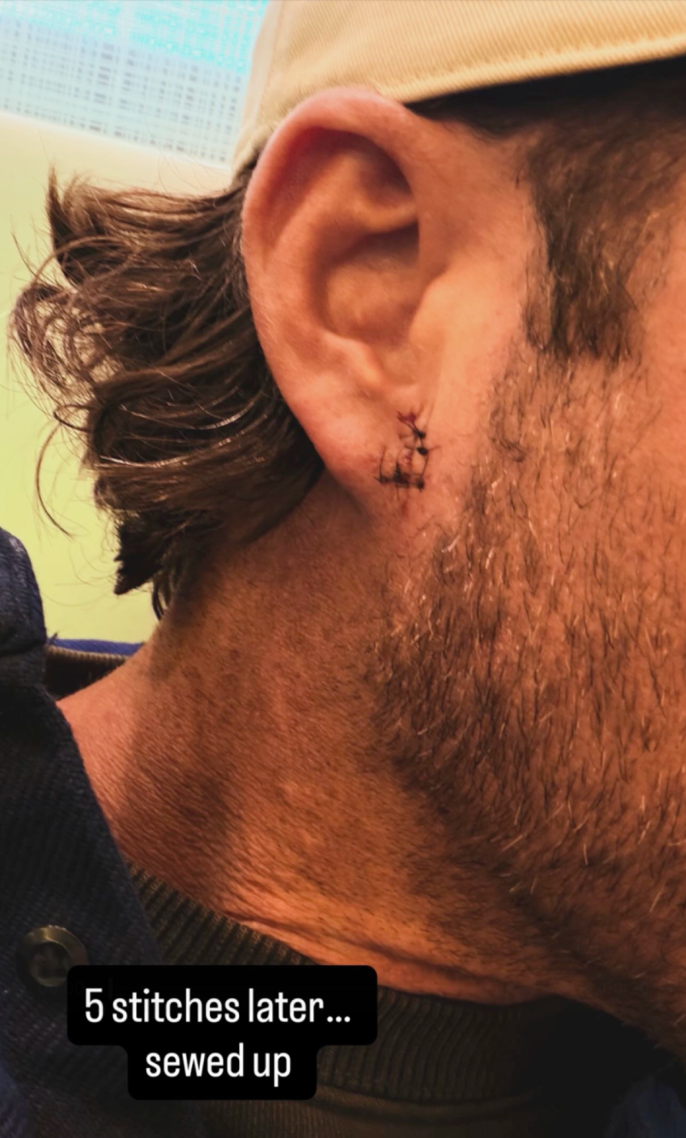 Riley Green Gets 5 Stitches After Fan Throws Phone at His Ear Him Makes Him Bleed Sewed Up