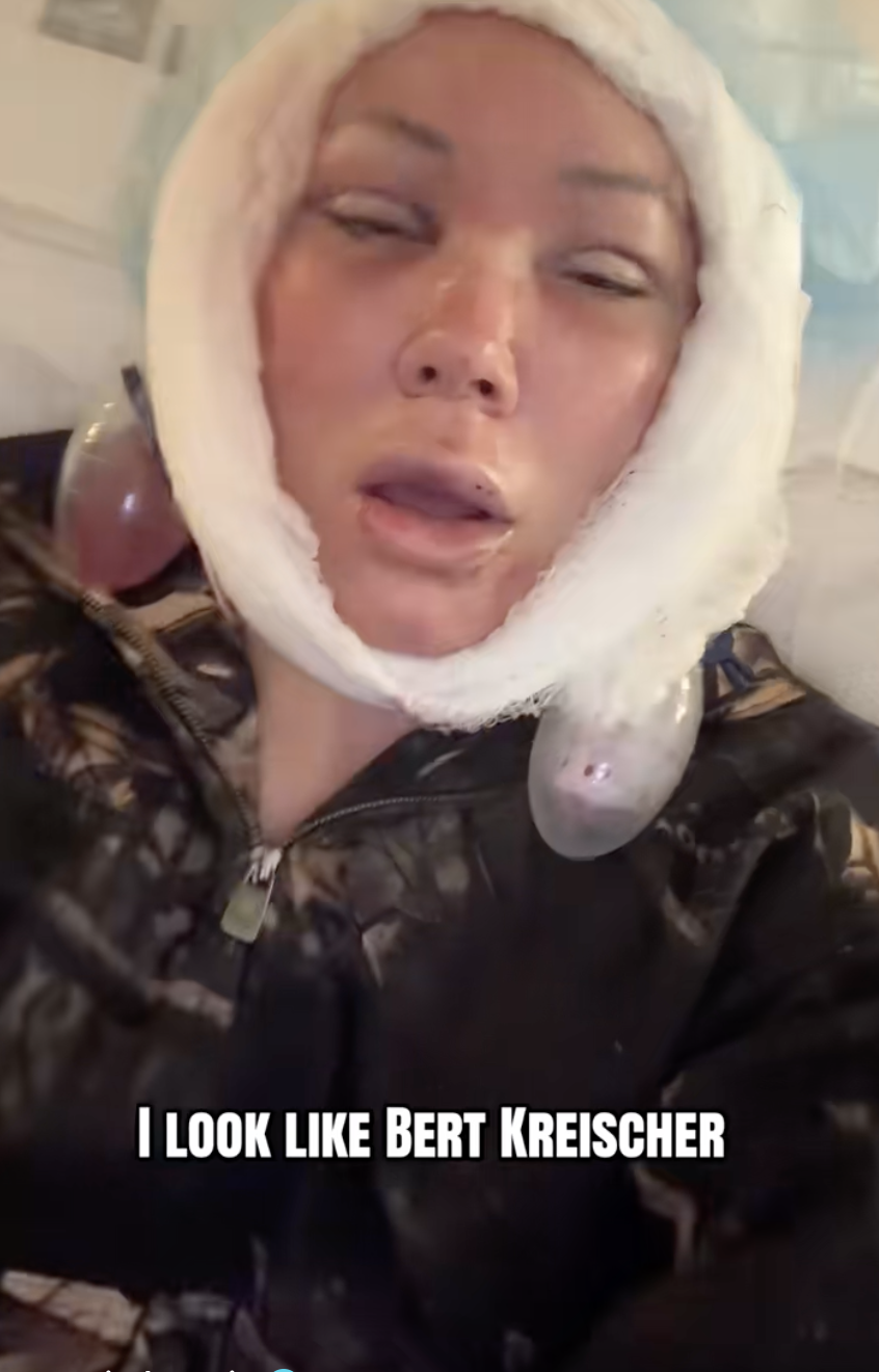 Bunnie Xo Says Burning Skin Smelled Like 'Pork Rinds' During Facelift