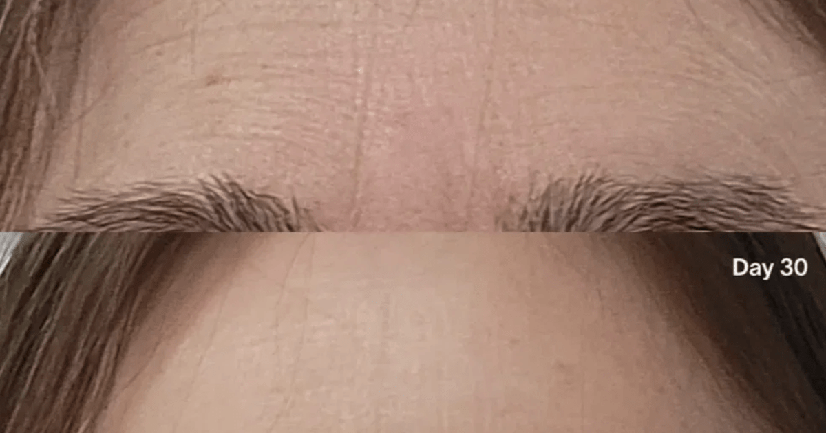 Wrinkles Between Your Eyebrows? This 3-Minute Treatment Can Make You Look 10 Years Younger Wrinkles Between Your Eyebrows? This 3-Minute Treatment Can Make You Look 10 Years Younger