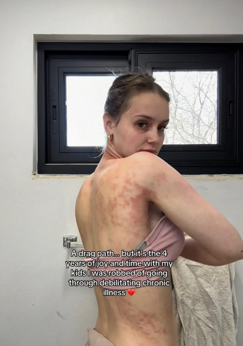 Mikayla Matthews Claps Back at People Minimizing Her Chronic Skin Condition as Just Rashes