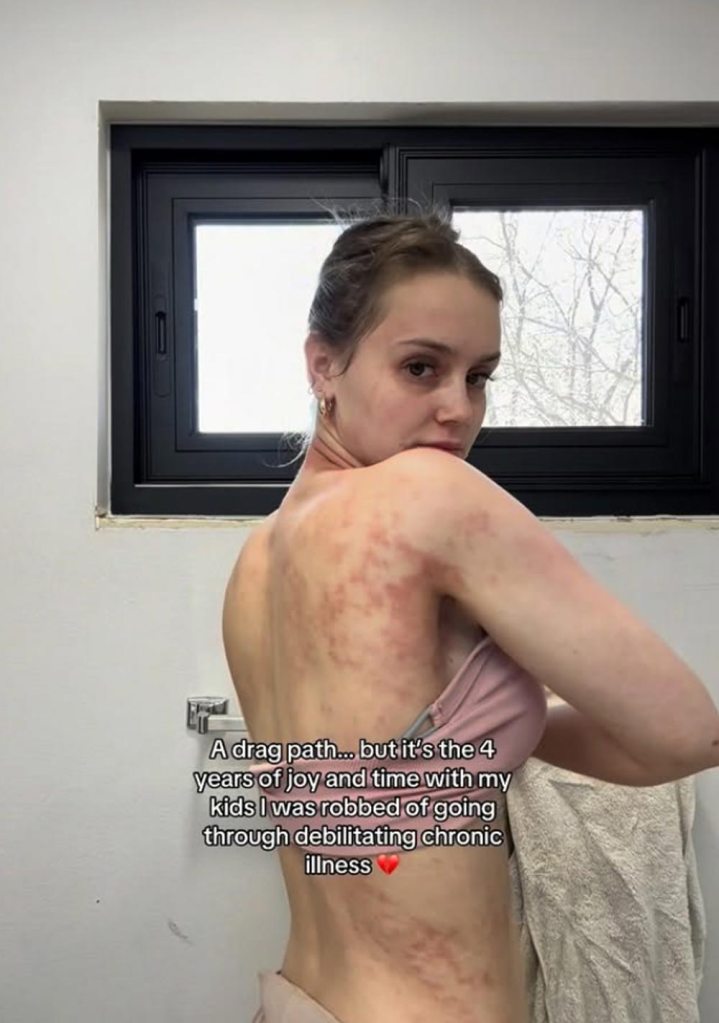 Mikayla Matthews Claps Back at People &lsquo;Minimizing&rsquo; Her Chronic Skin Condition