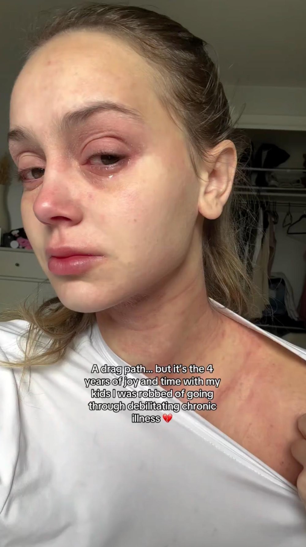 Mikayla Matthews Claps Back at People Minimizing Her Chronic Skin Condition as Just Rashes