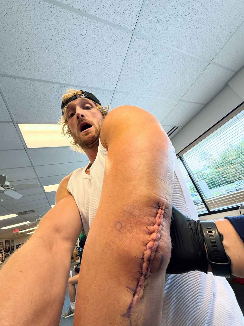 Logan Paul Posts Grotesque Photos After Tricep Surgery