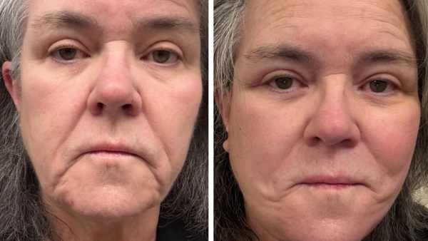 Rosie O'Donnell Shares Before-And-After Photos of Facelift 1 Day After Revealing Cosmetic Procedure