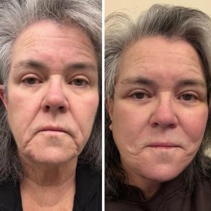 Rosie O'Donnell Shares Before-And-After Photos of Facelift 1 Day After Revealing Cosmetic Procedure