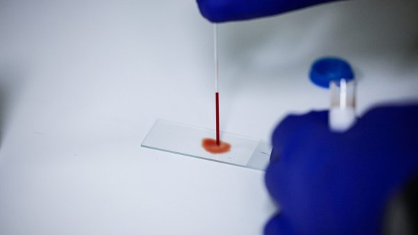 Getty Images 2279831686 Blood sample in lab