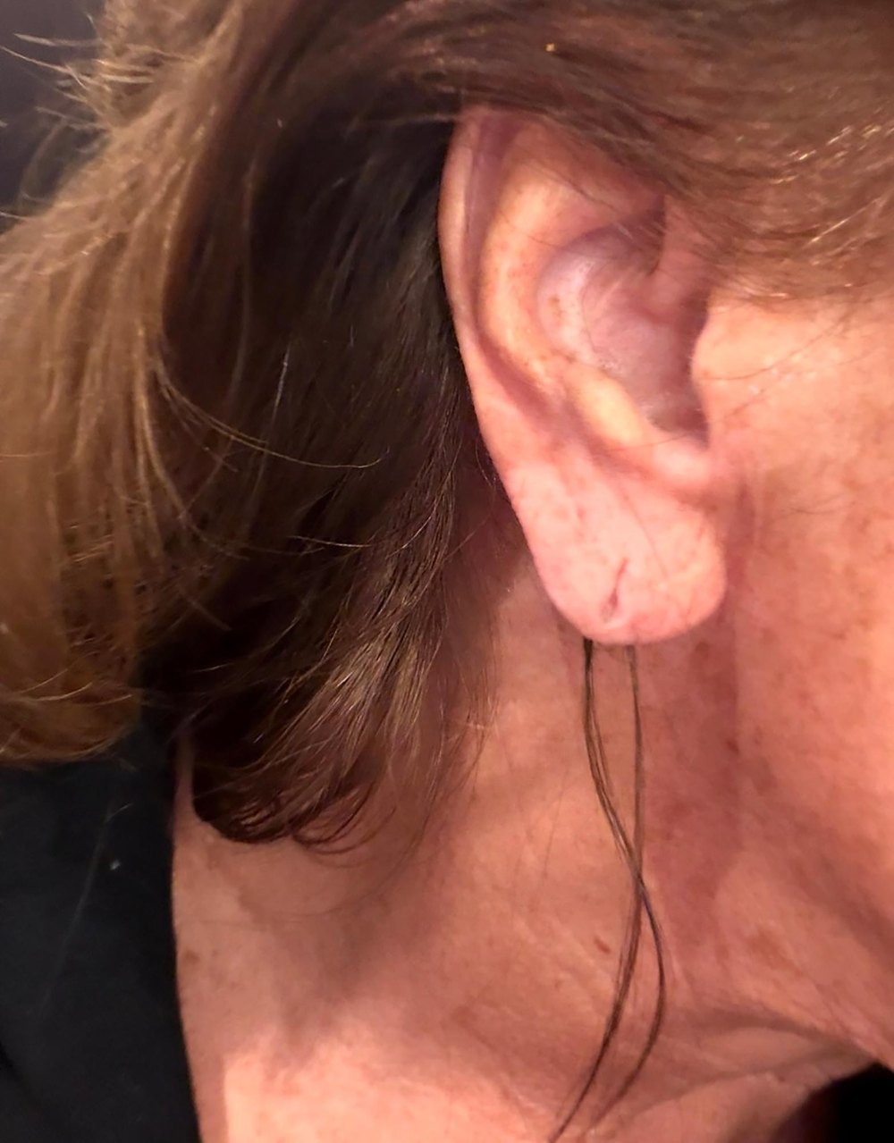 Abby Lee Miller Gushes Over Results of 1K Ear Rejuvenation Surgery