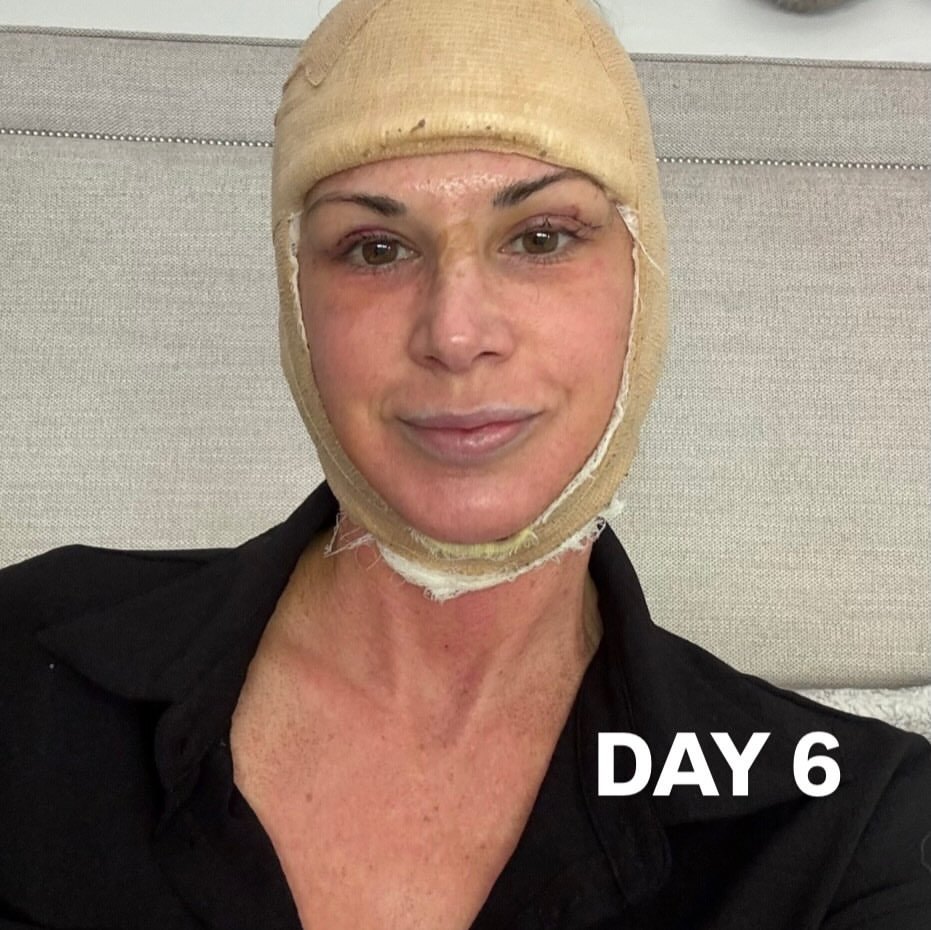 Alexis Bellino Shows Facelift Results, Details Recovery