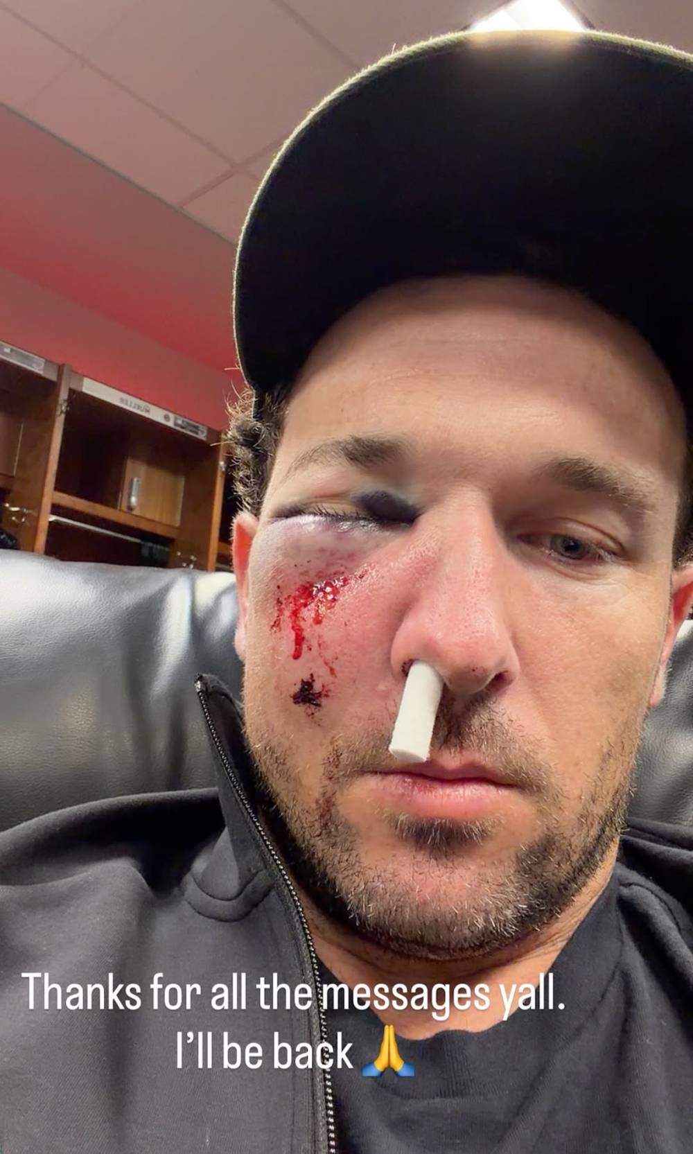 Cubs Alex Bregman Shares Gnarly Photo After Getting Hit in Face by Foul Ball