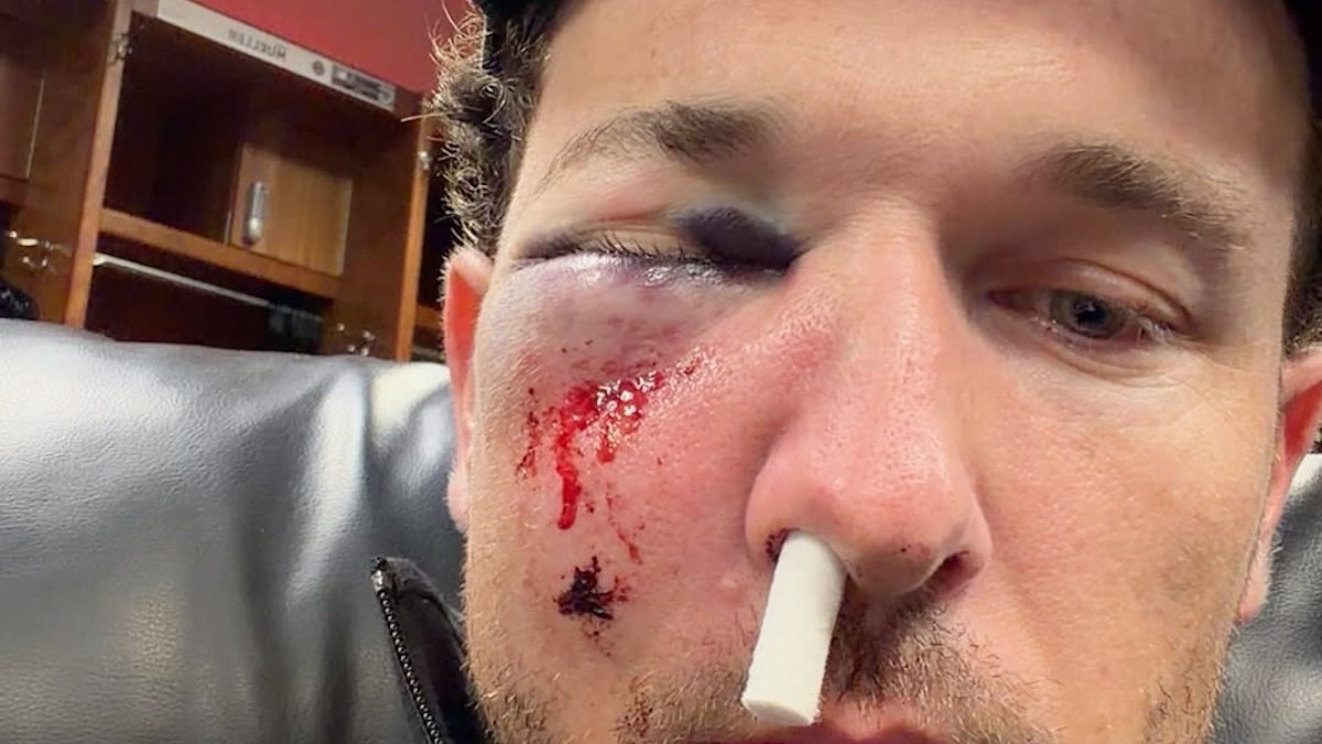 Cubs’ Alex Bregman Shares Gnarly Photo After Getting Hit in Face by Foul Ball