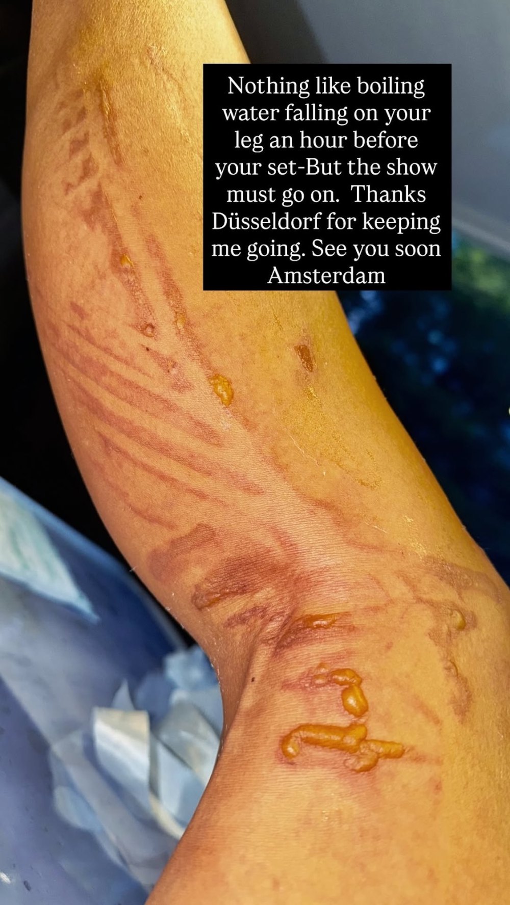 Nicole Scherzinger Shares Gruesome Pic After ‘Boiling’ Water Fell on Her Leg: ‘Show Must Go On’
