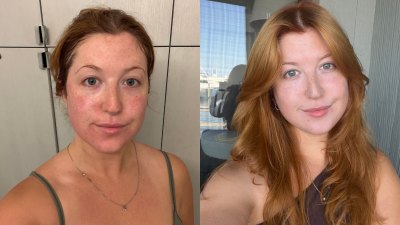 PDRNcreambeforeafter