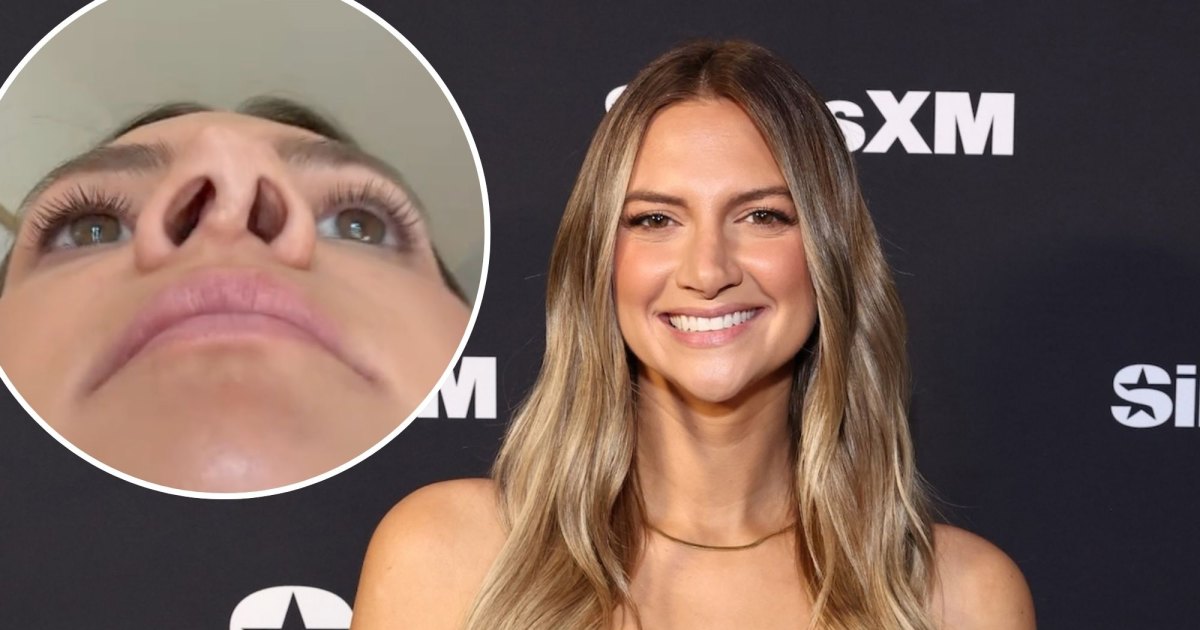 Allison Kuch Shows Close-Up of Her ‘Botched’ Nose After 4 Rhinoplasties: ‘Falling Off to 1 Side’