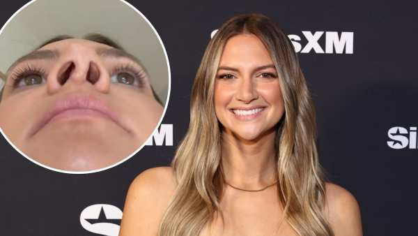 Allison Kuch Shows Her ‘Botched’ Nose After 4 Surgeries