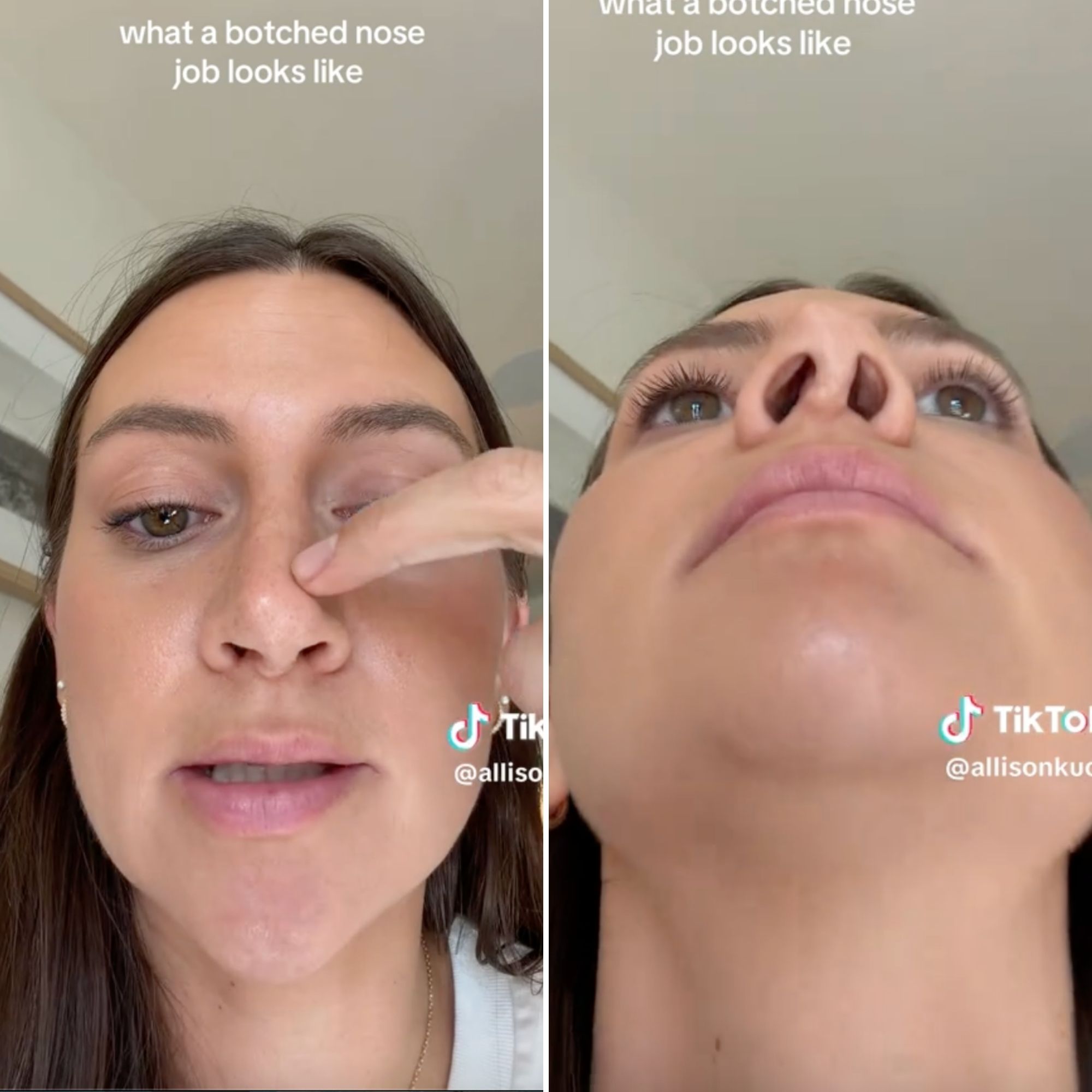Allison Kuch Shows Close-Up of Her ‘Botched’ Nose After 4 Rhinoplasties