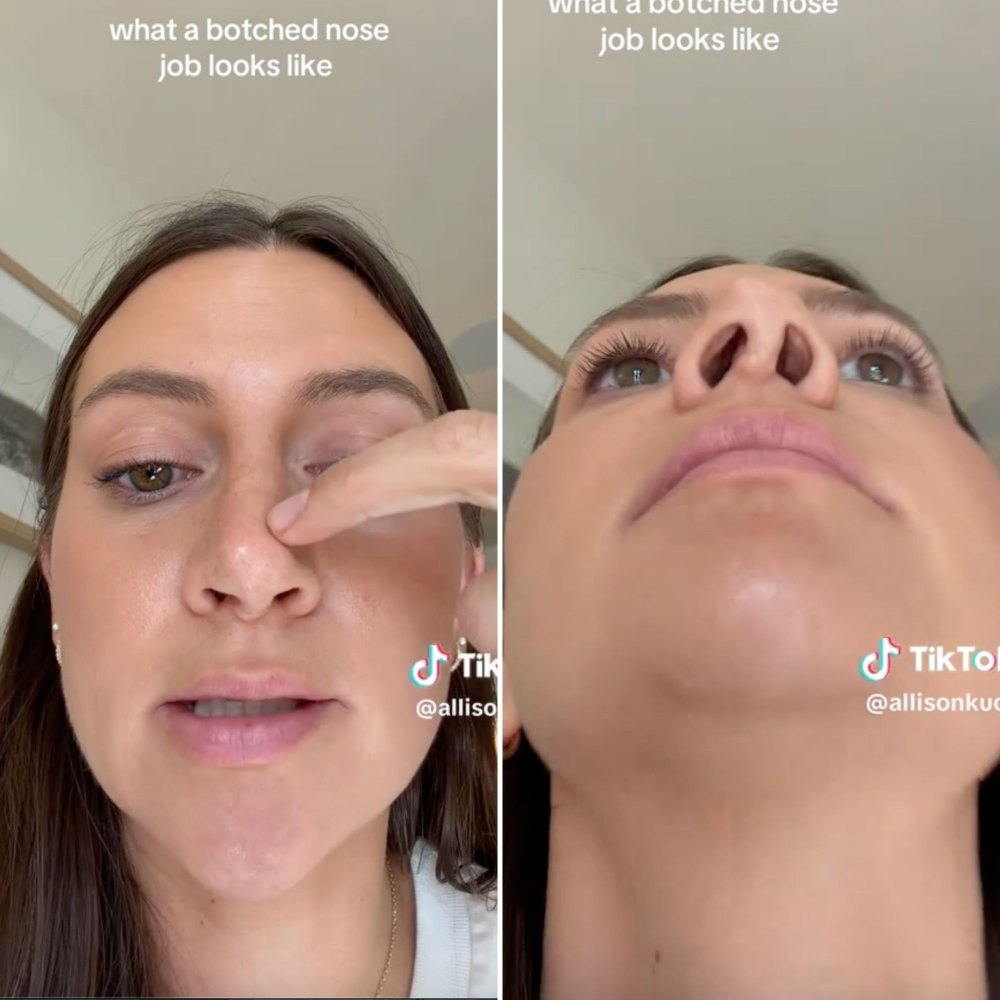 Allison Kuch Shows Her ‘Botched’ Nose After 4 Surgeries