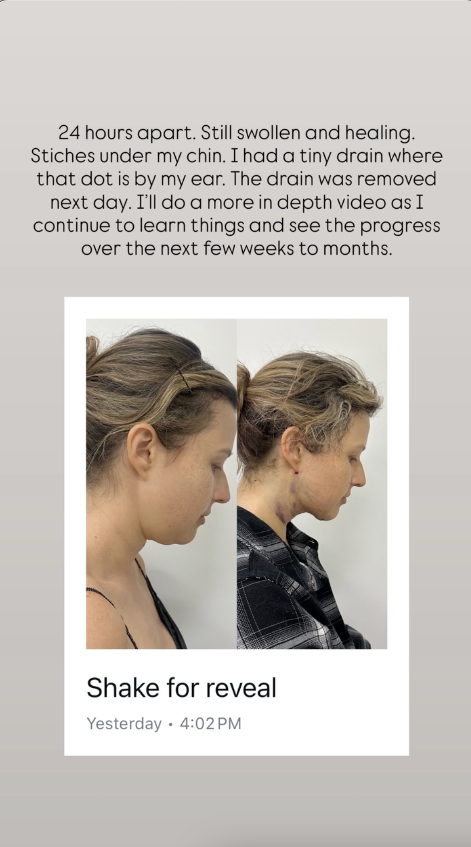 katie-thurston-before-and-after