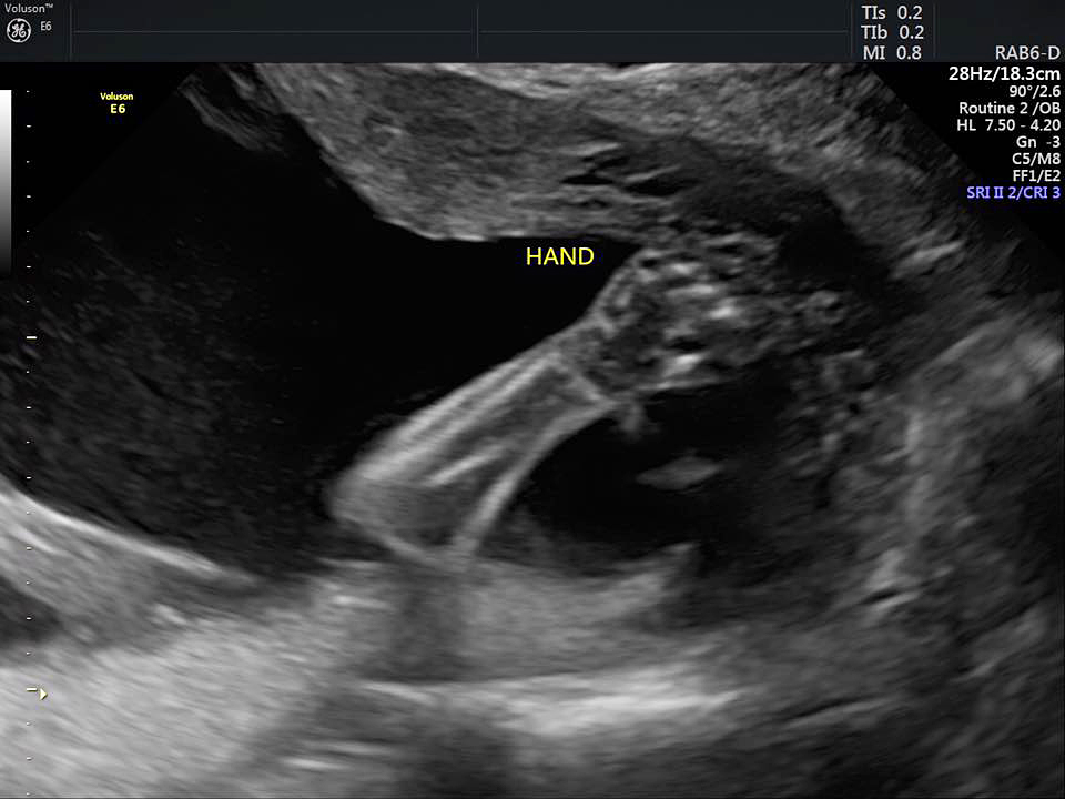 Keri Young ultrasound