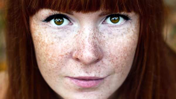 Freckles
